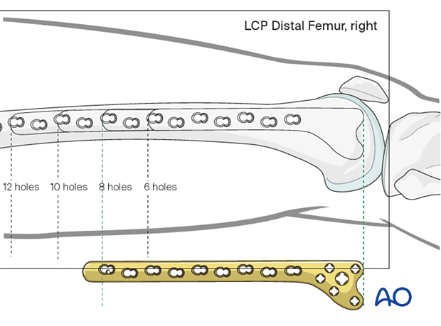 Determining the required length of the Condylar LCP