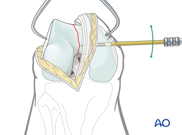Reduction of the articular block