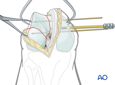 Oref Leg ORIF - Lag screw (epiphysis); ORIF - Bridge plate (metaphysis) for ...