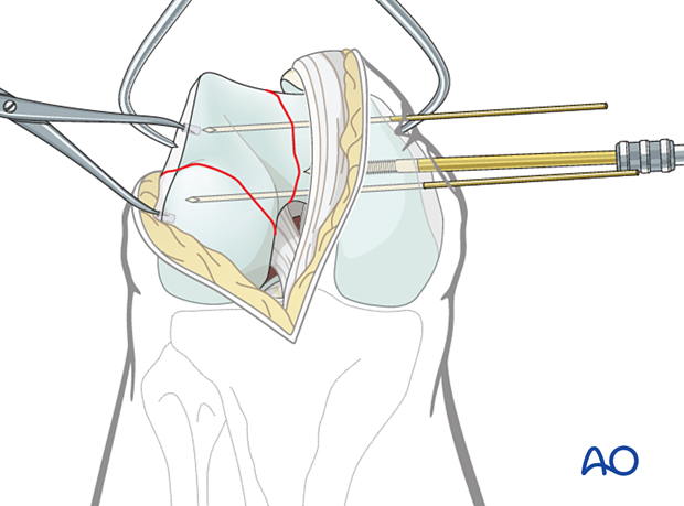 Insertion of K-wires in the distal articular block