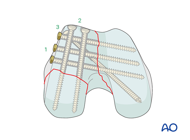End-on view of the articular block fixation.