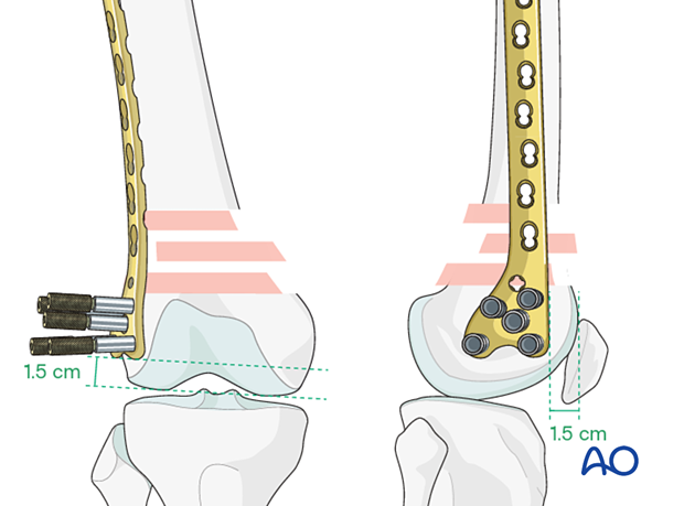 Position on the distal femur