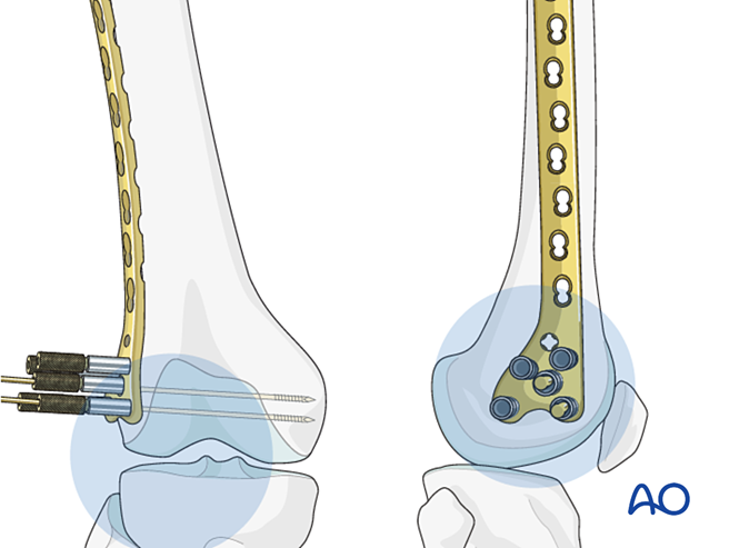 Oref Leg ORIF - Lag screw (epiphysis); ORIF - Bridge plate (metaphysis) for ...