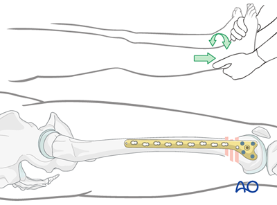 Oref Leg ORIF - Lag screw (epiphysis); ORIF - Bridge plate (metaphysis) for ...