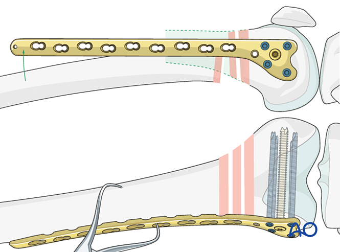 Oref Leg ORIF - Lag screw (epiphysis); ORIF - Bridge plate (metaphysis) for ...