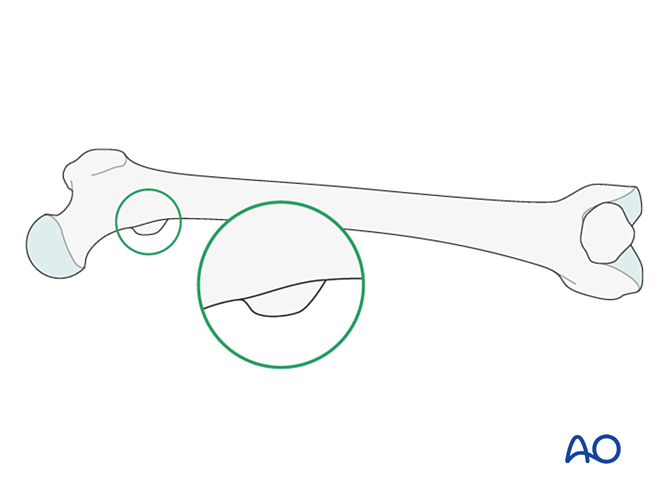 ORIF - Lag screw (epiphysis); ORIF - Bridge plate (metaphysis) for ...