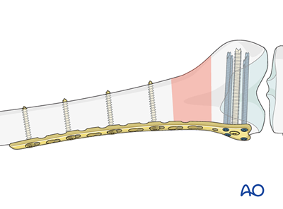 Oref Leg ORIF - Lag screw (epiphysis); ORIF - Bridge plate (metaphysis) for ...
