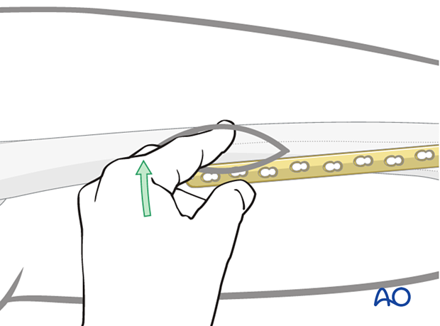 Incision over proximal two holes