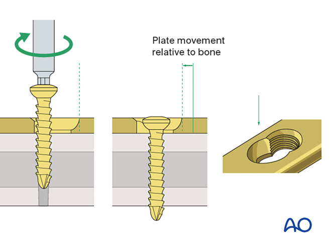 MIO - Compression (or bridging) plate for Extraarticular fracture, wedge