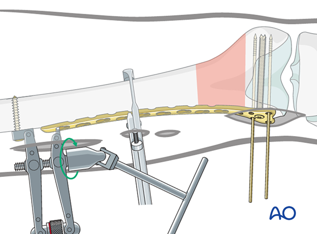 大腿骨近位部骨折 Osteosynthesis & Arthroplasty ORIF - Lag screw (epiphysis); MIO - Compression plate