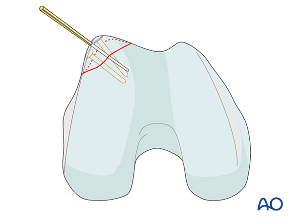 Fixation using absorbable pins