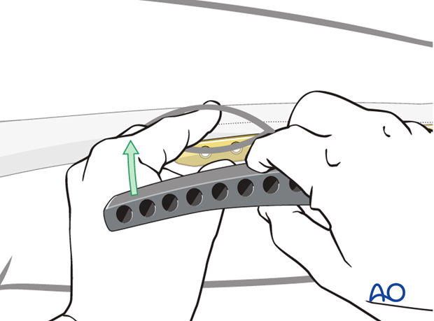 Proximal plate position