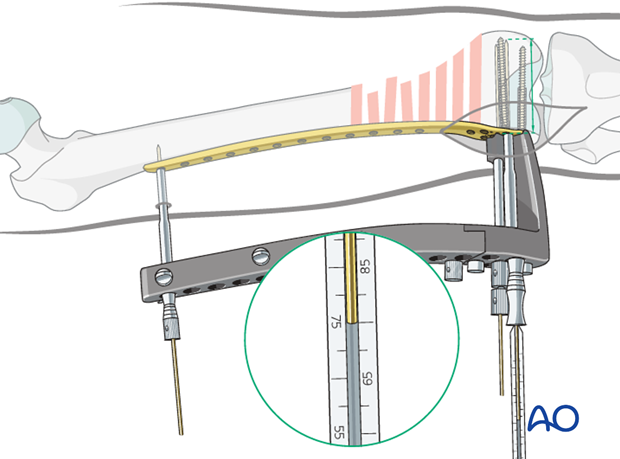 Determination of lag screw length