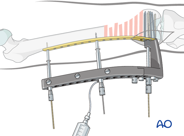 Reduction of the proximal femoral shaft with the pull reduction instrument