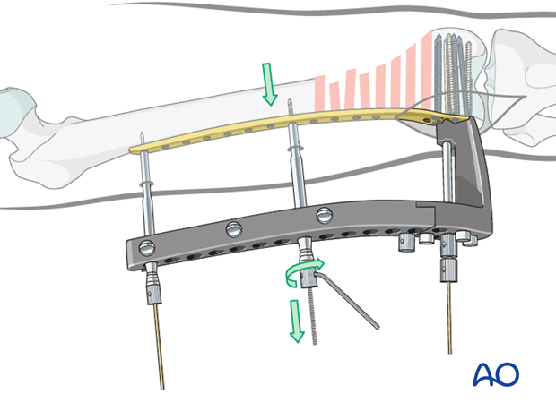 Reduction of the proximal femoral shaft with the pull reduction instrument