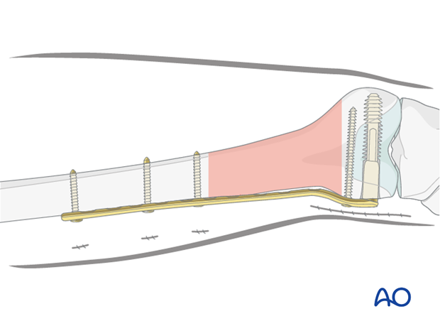 Plate used in bridging mode