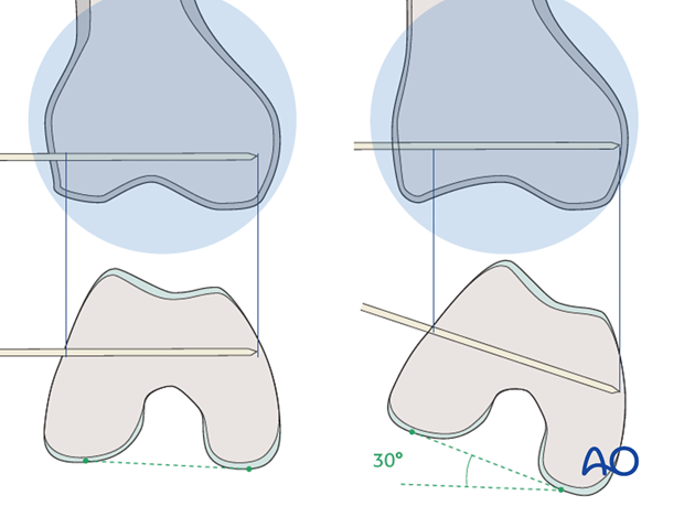 Pitafall – distal femur tapers form the posterior to the anterior
