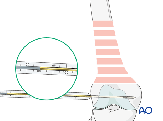 Screw length measurement