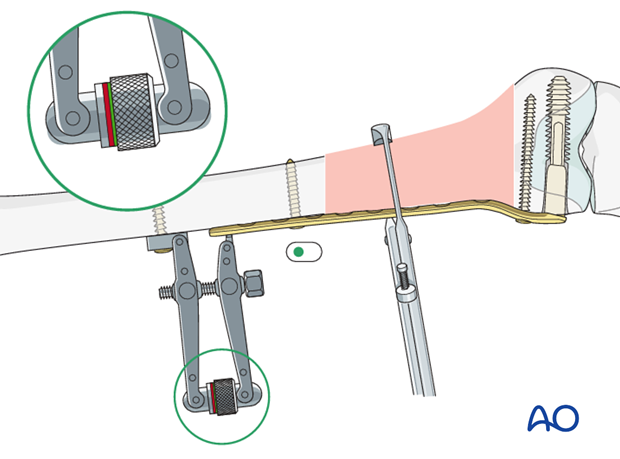 Use of articulated tension device