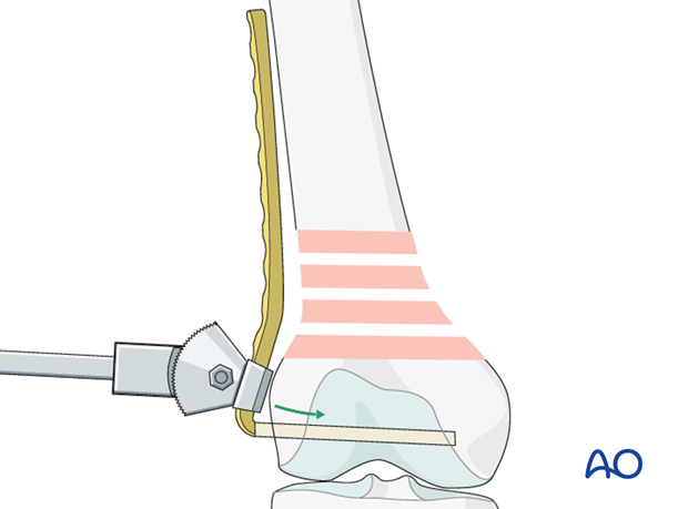 Plate insertion