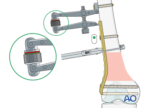 Use of the articulated tension device
