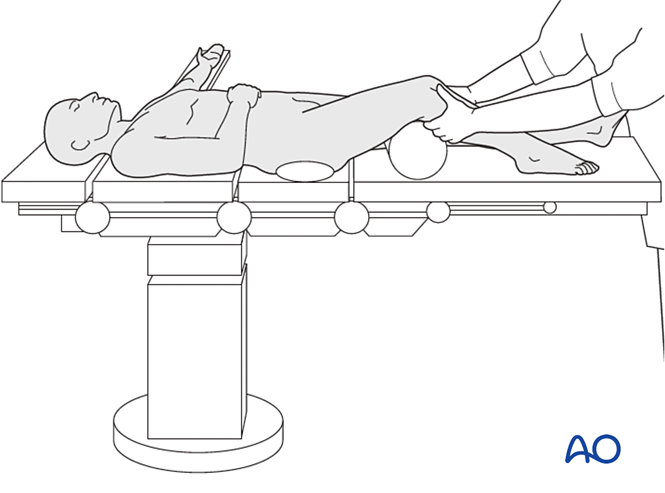 MIO - Retrograde nailing for Extraarticular fracture, wedge