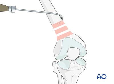 MIO - Retrograde nailing for Extraarticular fracture, wedge