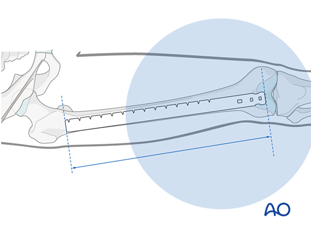 Determination of nail length using radiographic ruler