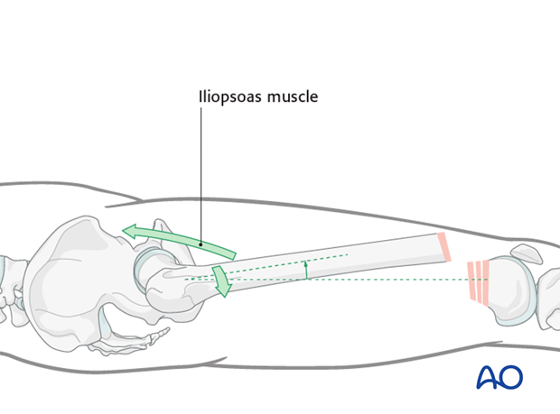 Pull of the iliopsoas muscle