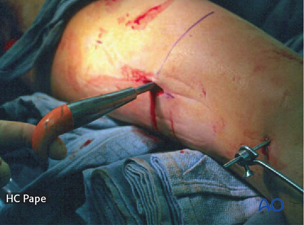Bone hook through minimal incision