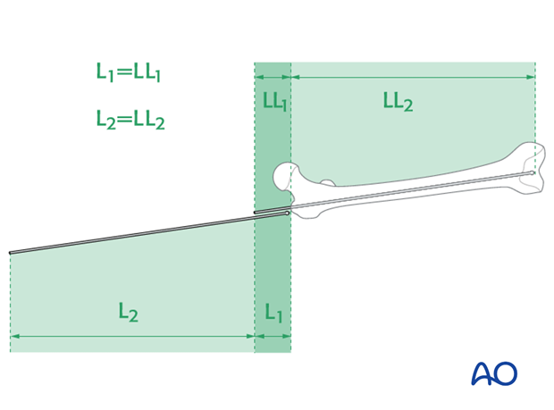 Determine nail length via guide wire