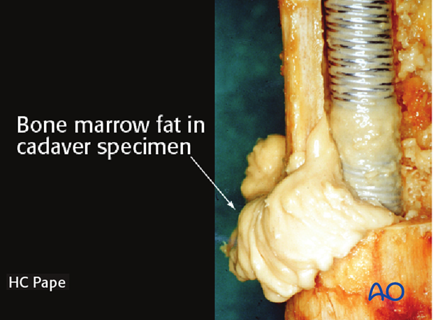 Image demonstrating fat extrusion