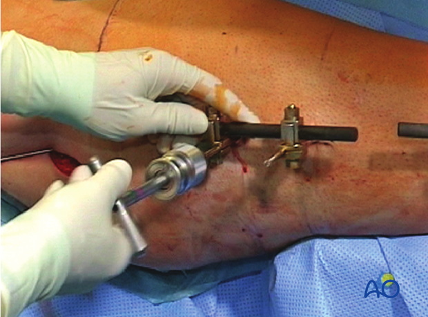 conversion from an external fixator to an intramedullary nail