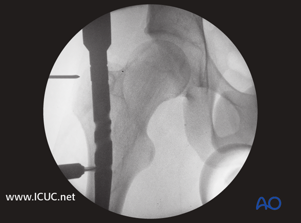 AP image of nail inserted in the proximal femur.