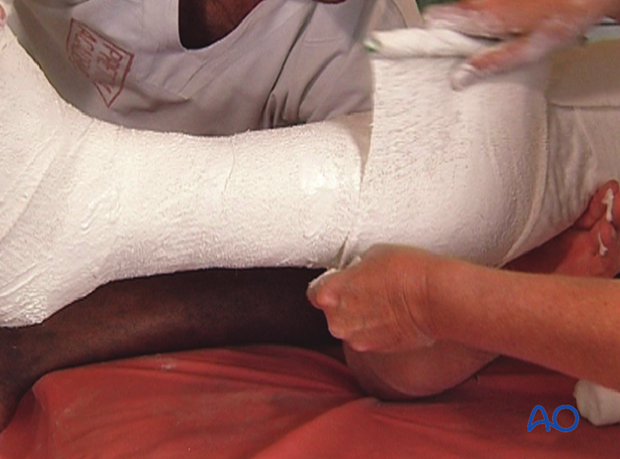Application of plaster bandage over the tibia shaft