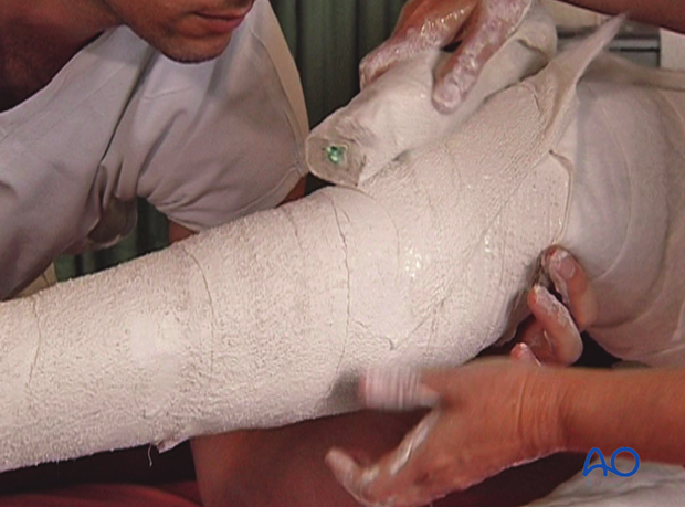 Application of additional plaster bandage over the proximal tibia