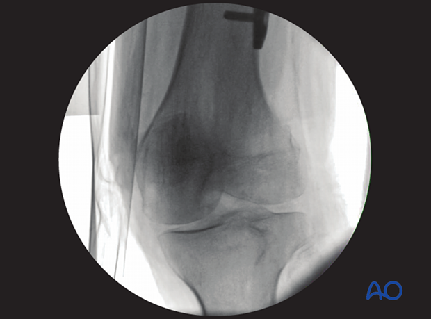 33 X551 Intraoperative imaging distal femur