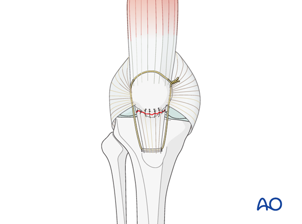 patella tendon repair