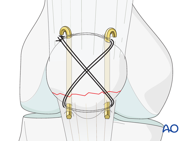 complete articular frontal coronal simple fracture of the distal third