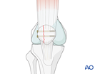 partial articular lateral sagittal simple fracture