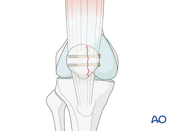 partial articular medial sagittal simple fracture
