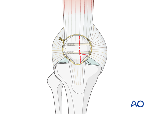 partial articular medial sagittal fragmentary fracture