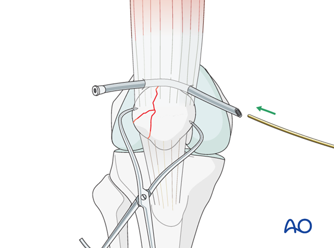 Cerclage wire for Partial articular, lateral sagittal fragmentary fracture