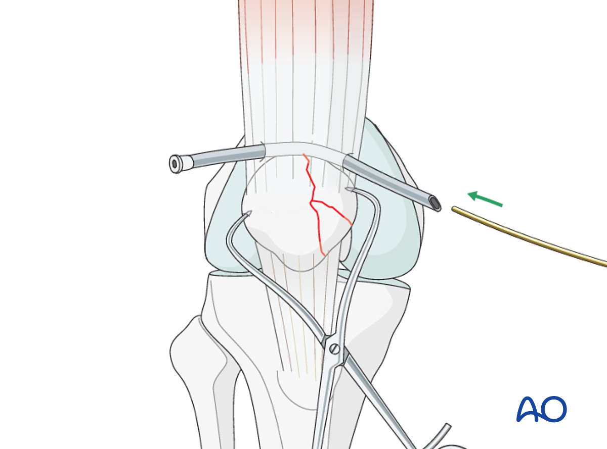 Cerclage Wire For Partial Articular, Medial Sagittal Fragmentary Fracture