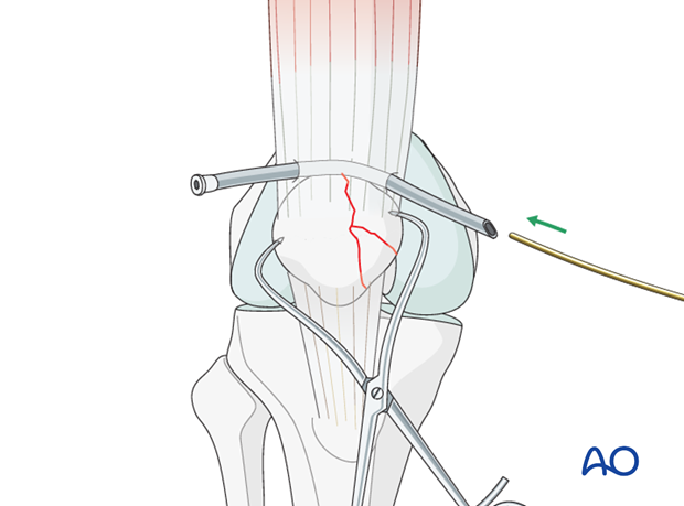 cerclage wire