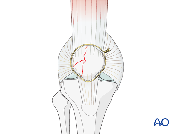 partial articular lateral sagittal fragmentary fracture