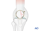 partial articular medial sagittal fragmentary fracture