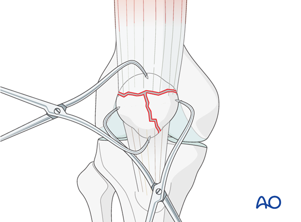 cerclage wire