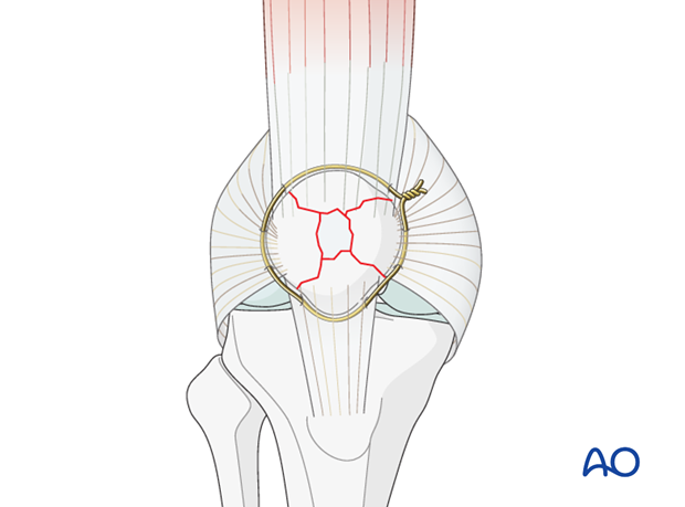 cerclage wire