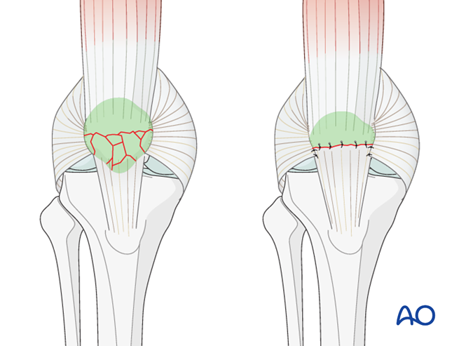 Salvage techniques for Complete articular, frontal/coronal ...